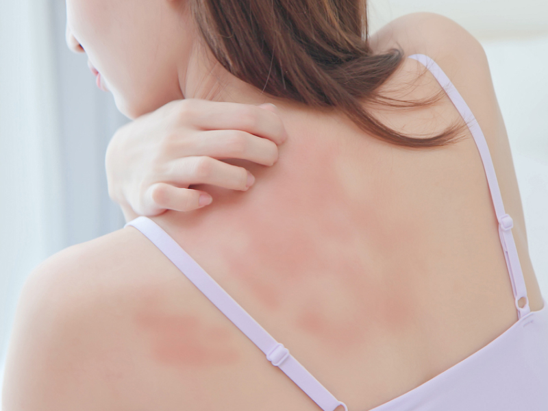 Frau mit Hautausschlag kratzt sich am Rücken